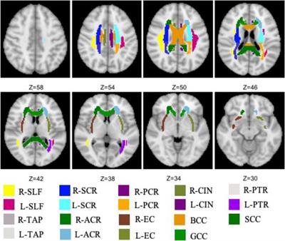 Diffusion Tensor Imaging Revealed Microstructural Changes in Normal-Appearing White Matter Regions in Relapsing–Remitting Multiple Sclerosis